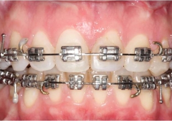 Mordida com 90 dias, após a cirurgia - Clínica Cliniface