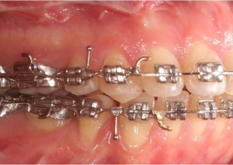 Mordida com 90 dias, após a cirurgia - Clínica Cliniface