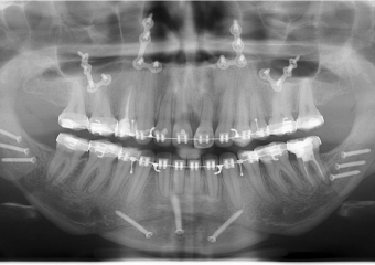 Raio x com 90 dias, após a cirurgia - Clínica Cliniface