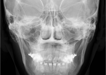 Telerradiografia frontal inicial - Clínica Cliniface