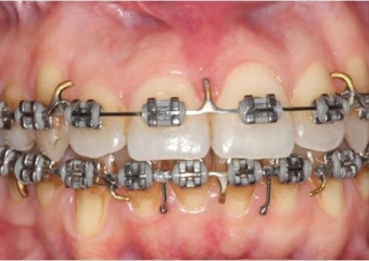 Mordida após a cirurgia - Clínica Cliniface