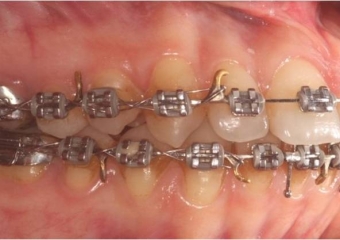 Mordida após a cirurgia - Clínica Cliniface