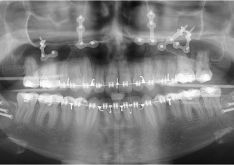 Raio x após a cirurgia - Clínica Cliniface