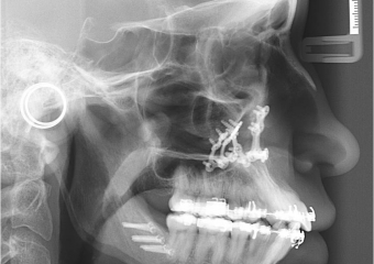 Telerradiografia após a cirurgia - Clínica Cliniface