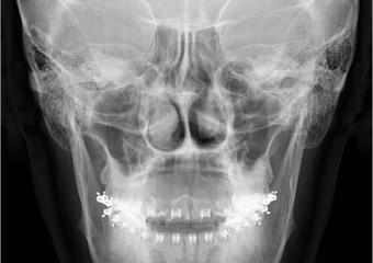 Telerradiografia frontal inicial - Clínica Cliniface