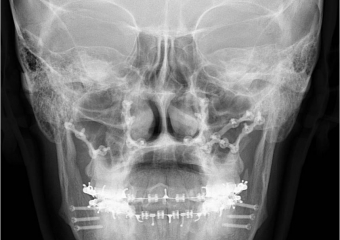 Telerradiografia frontal após a cirurgia - Clínica Cliniface