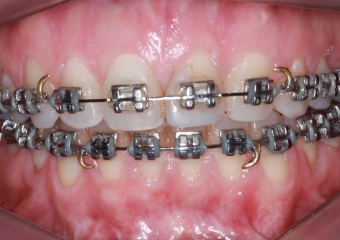 Mordida após cirurgia (Controle 14 meses)  - Clínica Cliniface