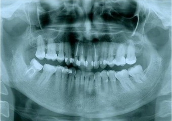 Raio x inicial com presença de lesão periapical no incisivo lateral superior esquerdo - Clínica Cliniface