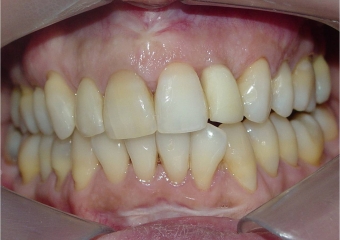 Imagem do dente provisório fixo sobre o implante - Clínica Cliniface