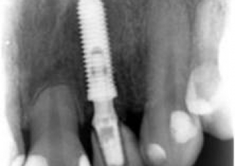 Raio x após extração do dente 22 por fratura de raiz, e instalação do implante Cone Morse - Clínica Cliniface