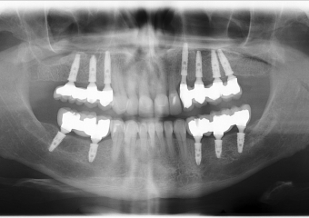 Rx Final - levantamento de seio bilateral - implantes - Clínica Cliniface