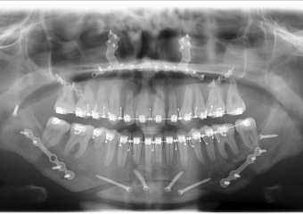 Rx Panorâmico após a cirurgia 2018 - Clínica Cliniface