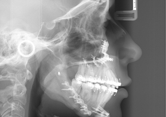 Telerradiografia após a cirurgia 2018  - Clínica Cliniface