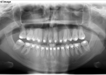 Rx Panorâmico inicial - Clínica Cliniface