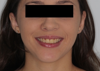 Sorriso após a cirurgia 2019 - Clínica Cliniface