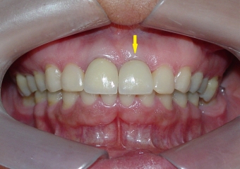 Sorriso Final, Controle em 2013 - Clínica Cliniface