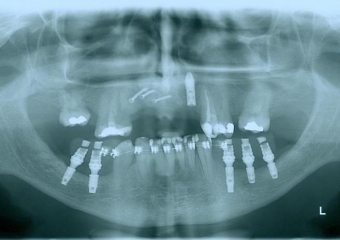 Enxerto em maxila em Fevereiro de 2012 - Clínica Cliniface