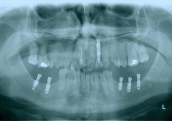 Implantes instalados, em Setembro de 2014 - Clínica Cliniface