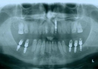 Raio - x Próteses provisórias, em 2015 - Clínica Cliniface