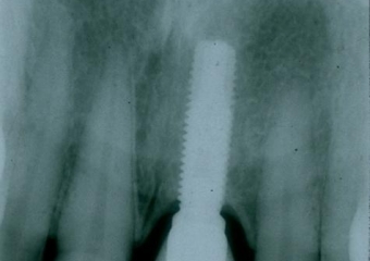 Raio X de 03 anos e 08 meses de controle - Clínica Cliniface