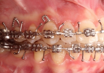 Mordida após a cirurgia - Clínica Cliniface