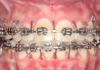 Mordida após a cirurgia - Clínica Cliniface