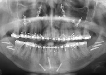 Raio x após a cirurgia - Clínica Cliniface