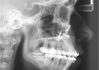 Telerradiografia após a cirurgia - Clínica Cliniface