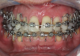 Mordida após a cirurgia - Clínica Cliniface