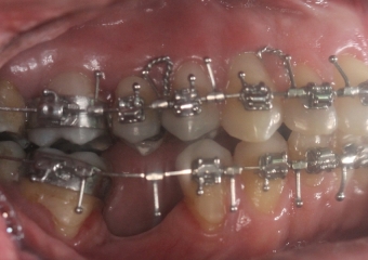 Mordida após a cirurgia - Clínica Cliniface