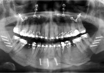 Raio x após a cirurgia - Clínica Cliniface