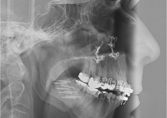 Telerradiografia após a cirurgia - Clínica Cliniface