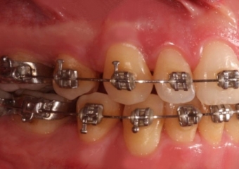 Mordida após a cirurgia - Clínica Cliniface