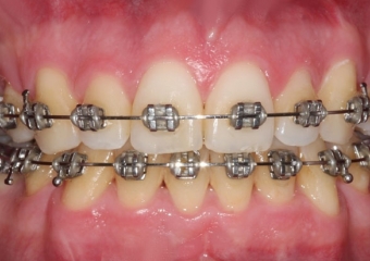 Mordida após a cirurgia - Clínica Cliniface