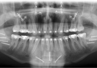 Raio x após a cirurgia - Clínica Cliniface