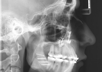 Telerradiografia após a cirurgia - Clínica Cliniface