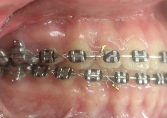 Mordida após a cirurgia - Clínica Cliniface