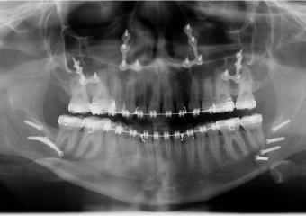 Raio x após a cirurgia - Clínica Cliniface