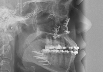 Telerradiografia após a cirurgia - Clínica Cliniface