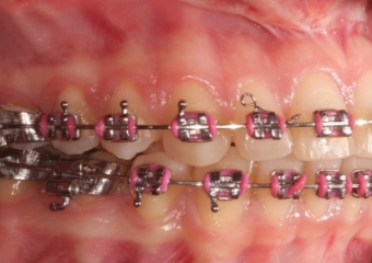 Mordida após a cirurgia - Clínica Cliniface