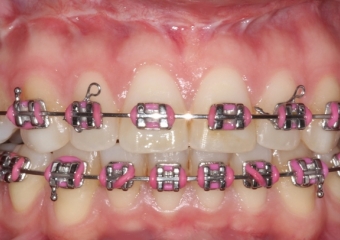 Mordida após a cirurgia - Clínica Cliniface