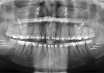 Raio x após a cirurgia - Clínica Cliniface