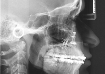 Telerradiografia após a cirurgia - Clínica Cliniface