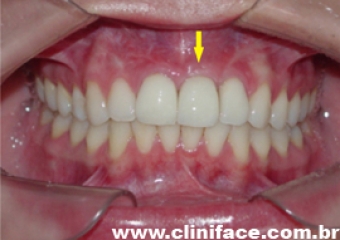 Prótese unitária de porcelana sobre implante - Clínica Cliniface