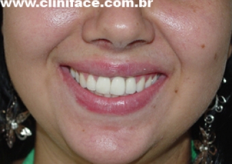 Sorriso final do caso terminado em fevereiro de 2010 - Clínica Cliniface