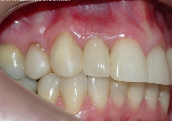 Prótese fixa sobre implante, finalizado em janeiro de 2010 - Clínica Cliniface