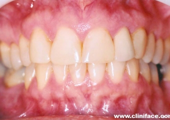 Imagem inicial e final de caso de agenesia dental, reabilitado com implante unitário no elemento 12 - Clínica Cliniface