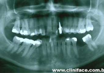 Raio X mostrando agenesia do elemento 12, reabilitado com implante e prótese fixa em porcelana - Clínica Cliniface