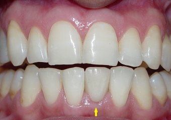 Imagens finais do caso terminado em fevereiro de 2010, com prótese em porcelana sobre implante - Clínica Cliniface