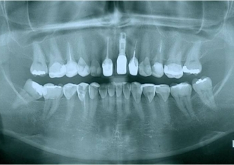 Raio X inicial com fratura radicular do dente 24 - Clínica Cliniface